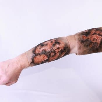 Upper & Lower Arm Burn Trauma Wound